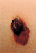 melanoma symptoms
