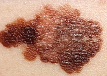 melanomas