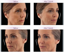 midface before and after