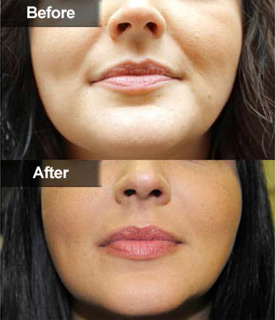 mouth before and after
