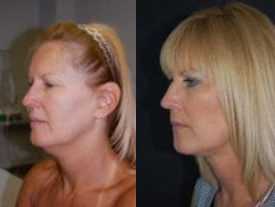 neck laser tightening before and after