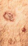 pre melanomas