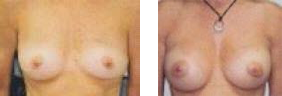 Saline implants