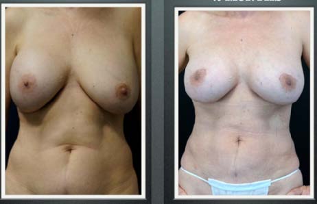 laser based lifts
