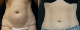 slimlipo abdomen