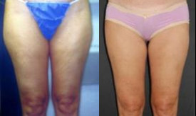 slimlipo thighs before and after