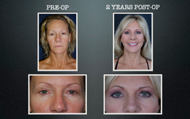 slimlipo to face