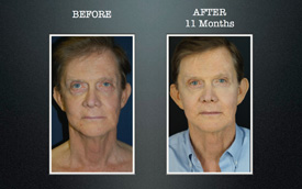 slimlipo to face