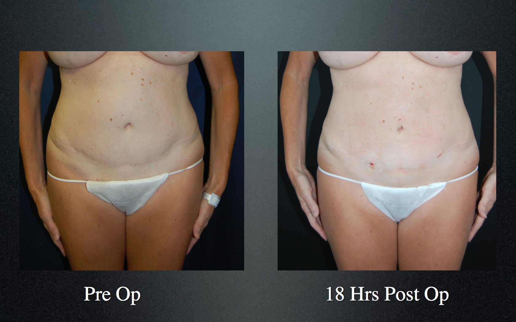slimlipo before and after