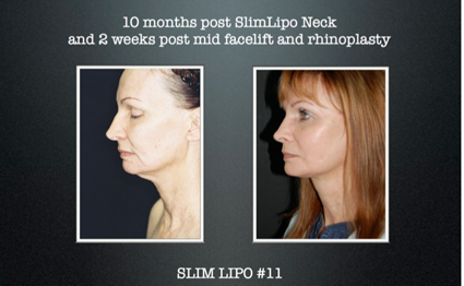 Slim Lipo Results