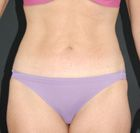 slimlipo after