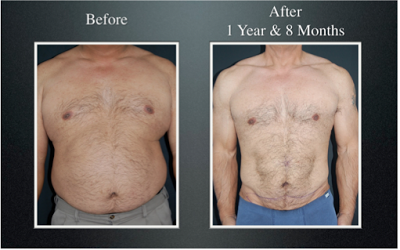 slimlipo before and after