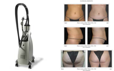 slim lipo machine and clinical results