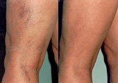 sclerotherapy for varicose veins