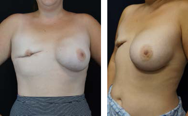 concentrated stem cell fat transfers to breasts before