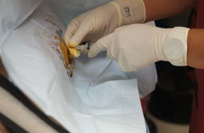 stem cell injection