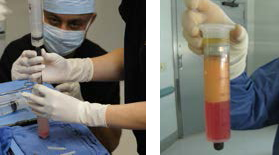 stem cell large volume extraction