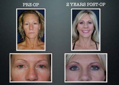 stem cell transfer to the face