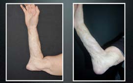 right upper extremity injury