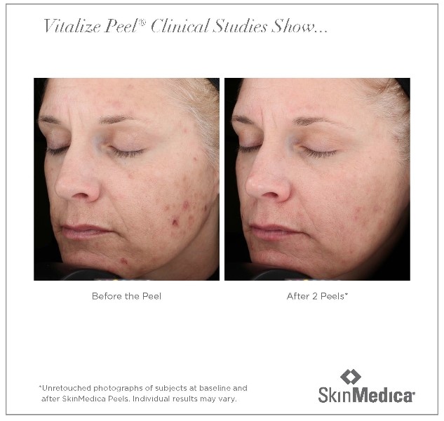 vitalize peel